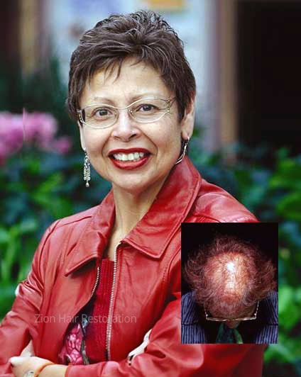 female-non-surgical-hair-replacement-for-alopecia-washington-utah Custom female non-surgical hair replacement for alopecia washington utah