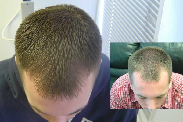 laser hair thereapy washington utah laser hair therapy washington utah