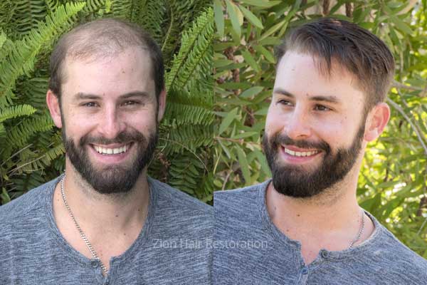 Non-surgical hair replacement before and after results Washington Utah