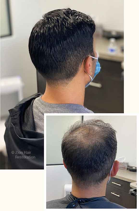 Men's custom hair replacement systems Washington Utah