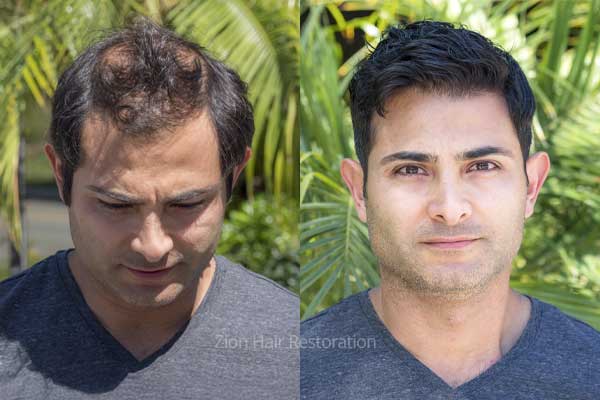 Men's hair restoration before and after results — Zion Hair Restoration Washington Utah