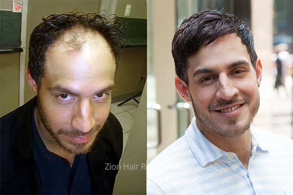 Men's custom non-surgical hair replacement before and after results Washington Utah