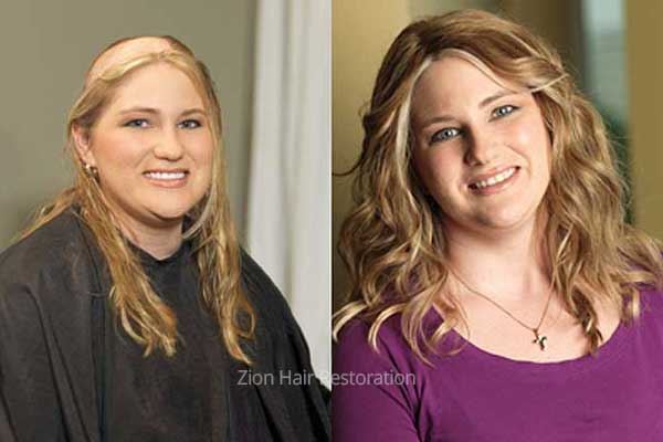 Women's hair replacement before and after results at Zion Hair Restoration in Washington, Utah