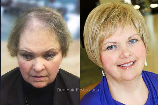 Women's non-surgical hair restoration before and after transformation at Zion Hair Restoration in Washington, Utah