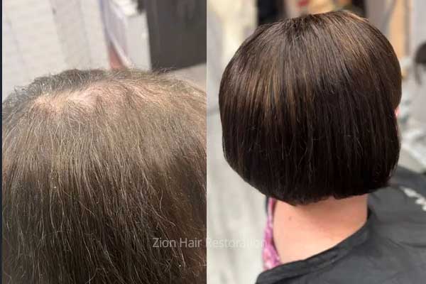 Before and after non-surgical hair replacement for women at Zion Hair Restoration, Washington, Utah
