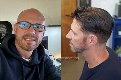 mens custom hair replacement systems washington utah